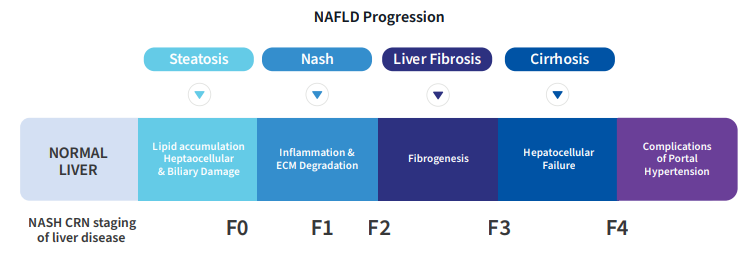 NAFLD Progrssion chart. Step 1: Normal Liver; Step 2: Steatosis, lipid accumulation heptaocellular & biliary damage (F0); Step 3: NASH,  Inflammation & ECM Degradation  (F1); Step 4: Liver fibrosis, Fibrogenesis (F3); Step 5: Cirrhosis, Hepatocellular  failure (F4); Step 6: complications of portal hypertension